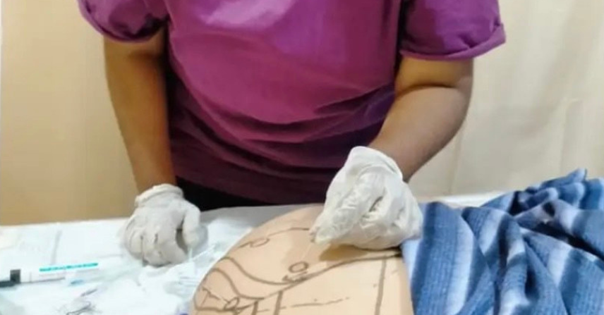 What are benefits of Dry Needling