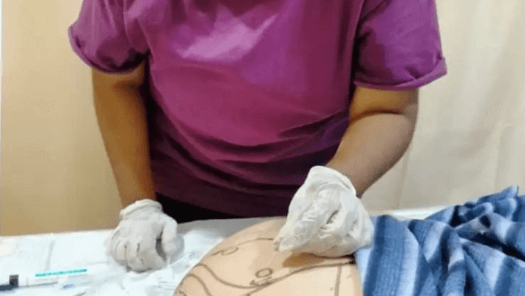 Dry Needling