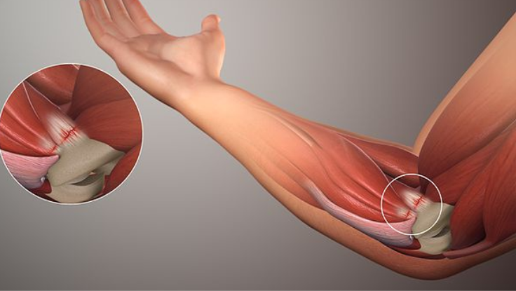 TENDONITIS