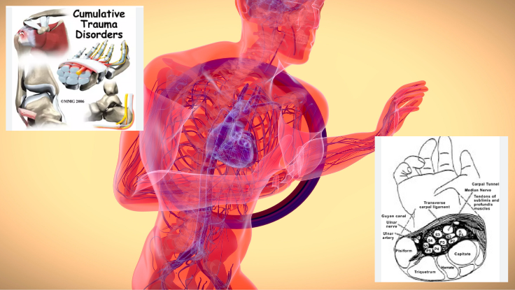 Cumulative trauma disorder