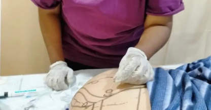 What are benefits of Dry Needling